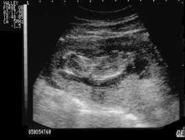 Ultrasound at 13 Weeks