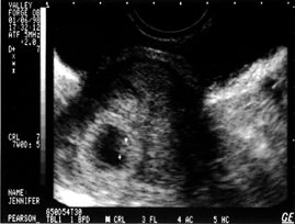 Ultrasound at 7 Weeks