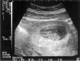 Ultrasound at 9 Weeks
